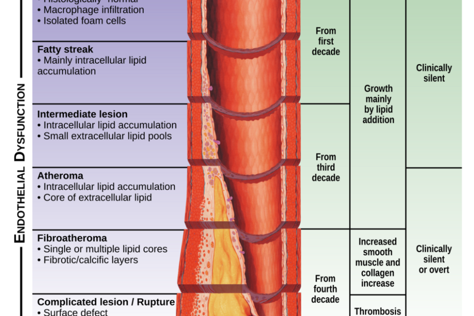 “Progression from endothelial dysfunction to atherosclerotic plaque formation in an artery cross-section.”