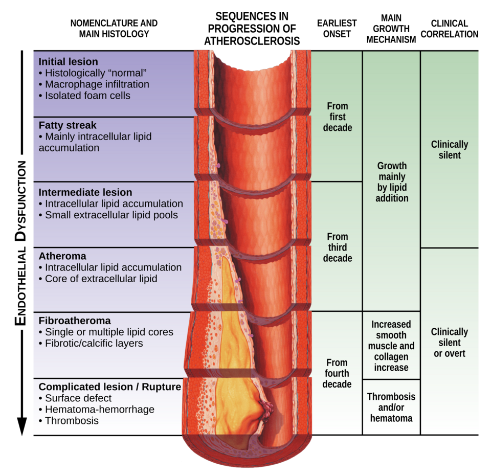 “Progression from endothelial dysfunction to atherosclerotic plaque formation in an artery cross-section.”