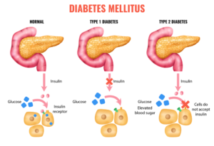 Comparative chart showing stages from normal glucose control to full Type 2 diabetes progression.