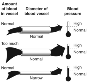 Illustration showing blood flow in normal vs narrowed vessels and high flow in normal vessel
