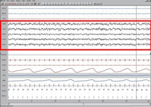 Polysomnography snapshot illustrating Stage N1 light sleep EEG.
