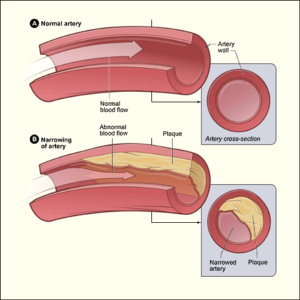 “Illustration showing normal artery vs. plaque buildup narrowing the vessel.”
