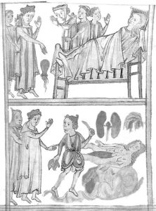 “Historic illustration of diabetes in medieval era”