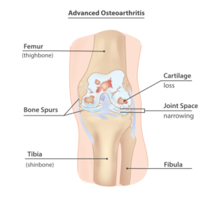 Medical illustration of knee osteoarthritis highlighting cartilage loss and joint changes