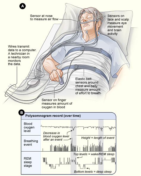Patient in sleep lab connected to sensors for an overnight polysomnography test.