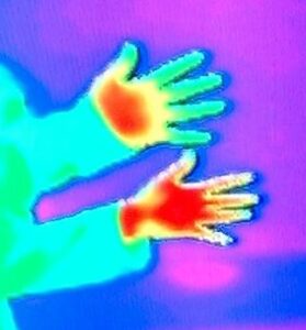 Thermal image comparing hand heat in a person with Raynaud’s versus normal circulation.