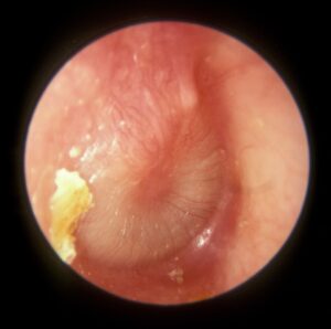 otoscopic photo of bulging, inflamed tympanic membrane in acute otitis media