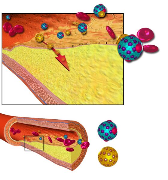 “Cross-section artery diagram showing plaque buildup and cholesterol involvement in atherosclerosis.”