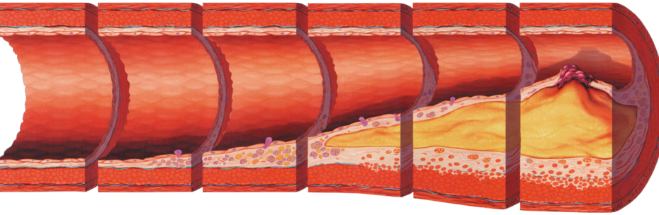 “Atherosclerosis progression: normal artery to plaque buildup—how high LDL drives cardiovascular disease”