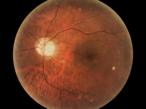 Color fundus photograph of a normal left retina showing optic disc and vessels.
