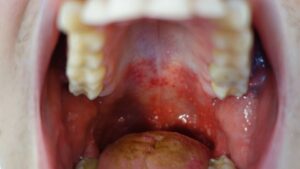 HFMD day-by-day guide mouth sores in children