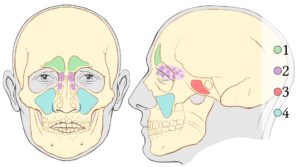 Labeled diagram of paranasal sinuses implicated in viral and bacterial rhinosinusitis