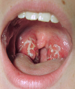 Streptococcal tonsillitis with tonsillar exudates confirming bacterial infection