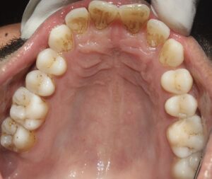 “Maxillary tooth with brown calculus deposit near the gumline”