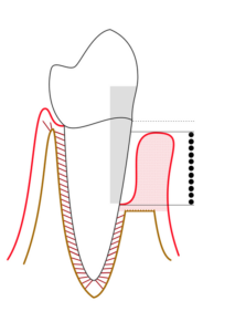 : “Diagram showing severe periodontitis with periodontal pocket depth scale”