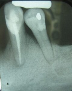 “Dental X-ray showing horizontal periodontal bone loss”