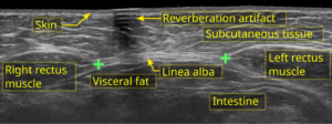 “Annotated ultrasound image illustrating diastasis recti separation”