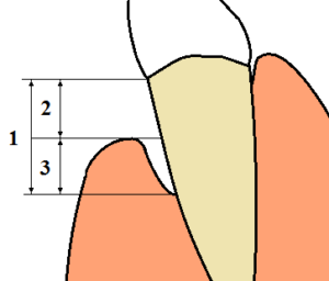 “Diagram labeling gingival recession, probing depth, and clinical attachment loss”