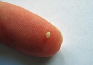 Close-up photo of a tonsillolith (tonsil stone) lodged in tonsil crypts