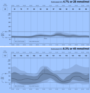 Illustration explaining hypoglycemia compared with normal blood sugar